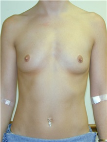 Breast Augmentation Before Photo by Randy Proffitt, MD; Mobile, AL - Case 21765