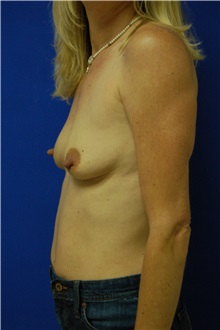 Breast Augmentation Before Photo by Randy Proffitt, MD; Mobile, AL - Case 21784