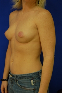 Breast Augmentation Before Photo by Randy Proffitt, MD; Mobile, AL - Case 21789