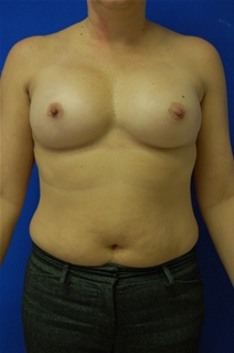Breast Augmentation After Photo by Randy Proffitt, MD; Mobile, AL - Case 21798