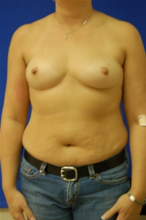 Breast Augmentation Before Photo by Randy Proffitt, MD; Mobile, AL - Case 21798