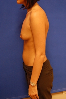 Breast Augmentation Before Photo by Randy Proffitt, MD; Mobile, AL - Case 21799