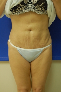 Tummy Tuck After Photo by Randy Proffitt, MD; Mobile, AL - Case 21806