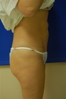 Tummy Tuck After Photo by Randy Proffitt, MD; Mobile, AL - Case 21806