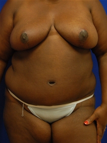 Tummy Tuck After Photo by Randy Proffitt, MD; Mobile, AL - Case 21808