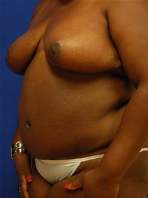 Tummy Tuck After Photo by Randy Proffitt, MD; Mobile, AL - Case 21808