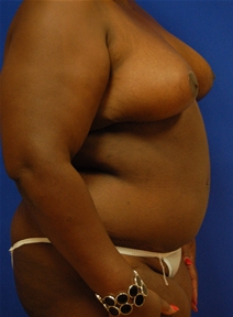 Breast Reduction After Photo by Randy Proffitt, MD; Mobile, AL - Case 21809