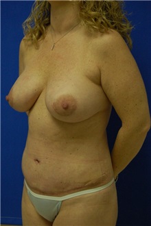 Tummy Tuck After Photo by Randy Proffitt, MD; Mobile, AL - Case 21812
