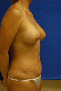 Tummy Tuck After Photo by Randy Proffitt, MD; Mobile, AL - Case 21813