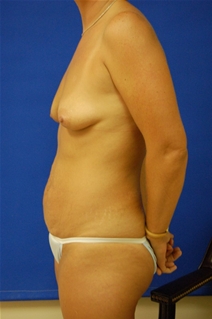 Breast Augmentation Before Photo by Randy Proffitt, MD; Mobile, AL - Case 21814