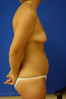 Breast Augmentation Before Photo by Randy Proffitt, MD; Mobile, AL - Case 21814