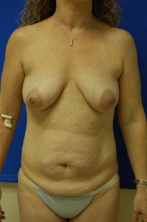 Breast Augmentation Before Photo by Randy Proffitt, MD; Mobile, AL - Case 21815