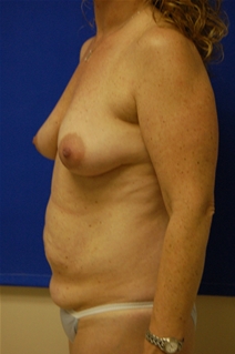 Breast Augmentation Before Photo by Randy Proffitt, MD; Mobile, AL - Case 21815