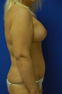 Tummy Tuck After Photo by Randy Proffitt, MD; Mobile, AL - Case 21816