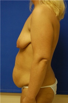 Breast Lift Before Photo by Randy Proffitt, MD; Mobile, AL - Case 21817