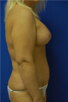 Breast Lift After Photo by Randy Proffitt, MD; Mobile, AL - Case 21817