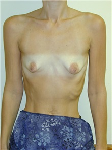 Breast Augmentation Before Photo by Randy Proffitt, MD; Mobile, AL - Case 21818