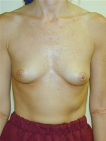 Breast Augmentation Before Photo by Randy Proffitt, MD; Mobile, AL - Case 21821