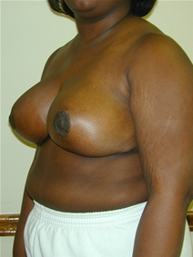 Breast Reduction After Photo by Randy Proffitt, MD; Mobile, AL - Case 21823