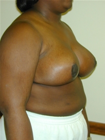 Breast Reduction After Photo by Randy Proffitt, MD; Mobile, AL - Case 21823