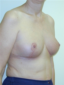 Breast Reduction After Photo by Randy Proffitt, MD; Mobile, AL - Case 21824