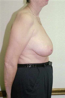 Breast Reduction Before Photo by Randy Proffitt, MD; Mobile, AL - Case 21824