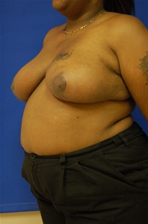 Breast Reduction After Photo by Randy Proffitt, MD; Mobile, AL - Case 21827