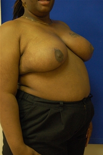 Breast Reduction After Photo by Randy Proffitt, MD; Mobile, AL - Case 21827