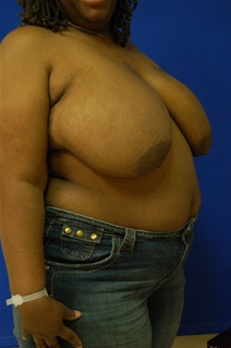 Breast Reduction Before Photo by Randy Proffitt, MD; Mobile, AL - Case 21827