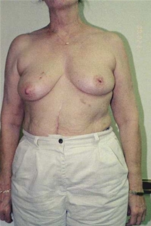 Breast Lift Before Photo by Randy Proffitt, MD; Mobile, AL - Case 21831