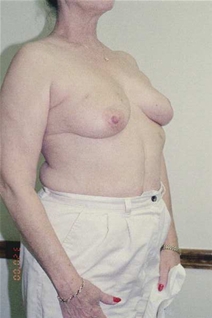 Breast Lift Before Photo by Randy Proffitt, MD; Mobile, AL - Case 21831