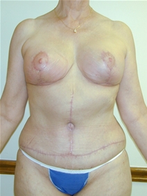 Tummy Tuck After Photo by Randy Proffitt, MD; Mobile, AL - Case 21832
