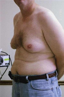 Male Breast Reduction Before Photo by Randy Proffitt, MD; Mobile, AL - Case 21833