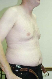 Male Breast Reduction After Photo by Randy Proffitt, MD; Mobile, AL - Case 21833