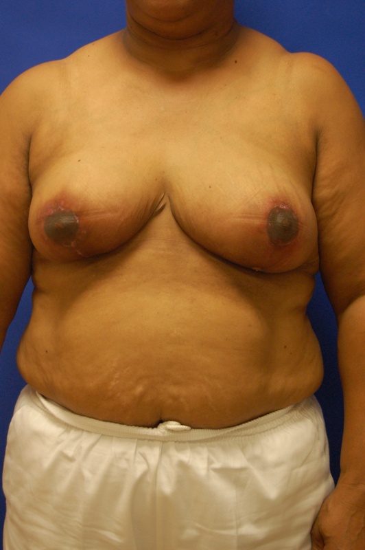 Breast Reduction Before and After Photos by Randy Proffitt, MD; Mobile, AL  - Case 21834