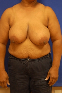 Breast Reduction Before Photo by Randy Proffitt, MD; Mobile, AL - Case 21834