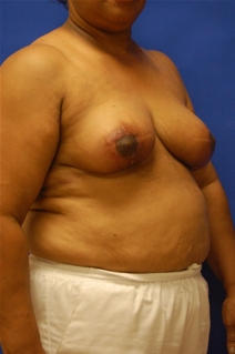 Breast Reduction After Photo by Randy Proffitt, MD; Mobile, AL - Case 21834
