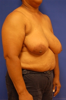 Breast Reduction Before Photo by Randy Proffitt, MD; Mobile, AL - Case 21834