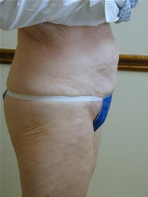 Liposuction After Photo by Randy Proffitt, MD; Mobile, AL - Case 21835