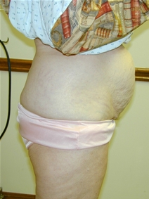 Liposuction Before Photo by Randy Proffitt, MD; Mobile, AL - Case 21835