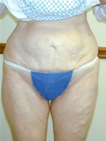 Tummy Tuck After Photo by Randy Proffitt, MD; Mobile, AL - Case 21836