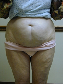 Tummy Tuck Before Photo by Randy Proffitt, MD; Mobile, AL - Case 21836