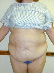 Tummy Tuck Before Photo by Randy Proffitt, MD; Mobile, AL - Case 21838