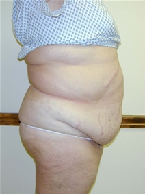 Tummy Tuck Before Photo by Randy Proffitt, MD; Mobile, AL - Case 21838