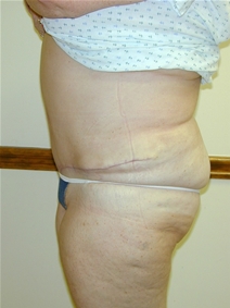 Tummy Tuck After Photo by Randy Proffitt, MD; Mobile, AL - Case 21838