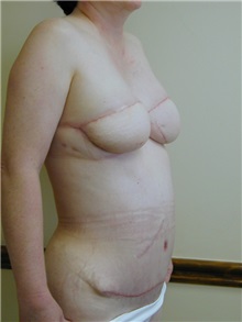Breast Reconstruction After Photo by Randy Proffitt, MD; Mobile, AL - Case 21849