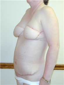 Breast Reconstruction Before Photo by Randy Proffitt, MD; Mobile, AL - Case 21849