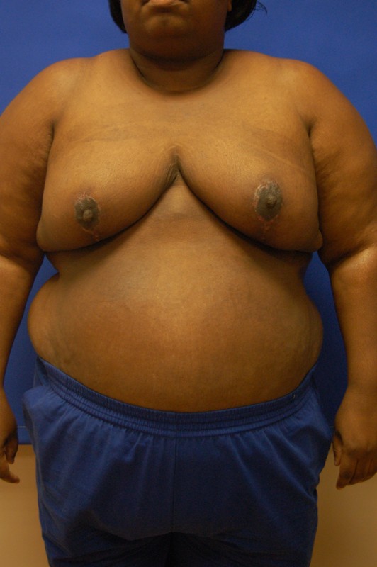 Breast Reduction Before and After Photos by Randy Proffitt, MD; Mobile, AL  - Case 21852