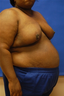 Breast Reduction After Photo by Randy Proffitt, MD; Mobile, AL - Case 21852