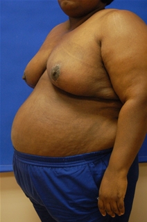 Breast Reduction After Photo by Randy Proffitt, MD; Mobile, AL - Case 21852